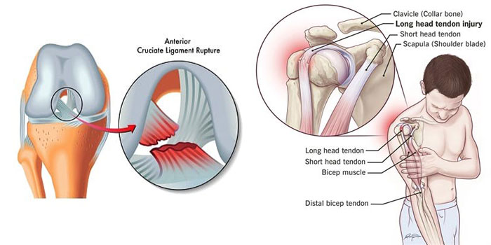 Tendon & Ligament Injury, Rupture, and Tear Treatment