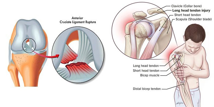 Ligament Injury, Rupture, and Tear Treatment in Thane